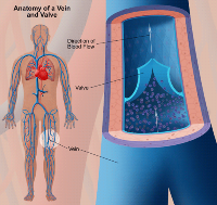 Варикоз глубоких вен нижних конечностей: симптомы, лечение