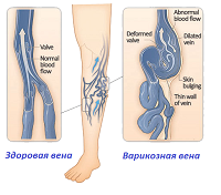 Синие вены на ногах: причины, лечение, как убрать?