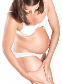 Профилактика варикоза у беременных